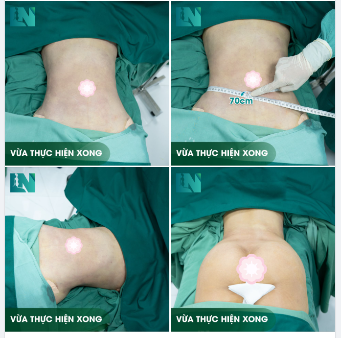 HÌNH ẢNH KHÁCH HÀNG VỪA THỰC HIỆN XONG COMBO HÚT MỠ TẠO DÁNG BỤNG - EO - HÔNG KẾT HỢP CẤY MỠ MÔNG