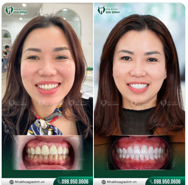 CẢI THIỆN RĂNG Ố VÀNG, TRẢ LẠI NỤ CƯỜI THẬT DUYÊN