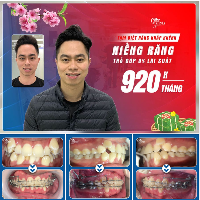 RĂNG KHẤP KHỂNH, LỆCH LẠC CẢI THIỆN RÕ RỆT SAU NIỀNG RĂNG