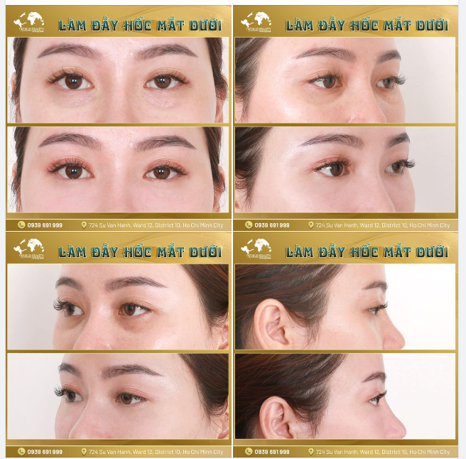Sở hữu thần sắc rạng rỡ, trẻ trung chỉ sau 15 phút bằng chất làm đầy