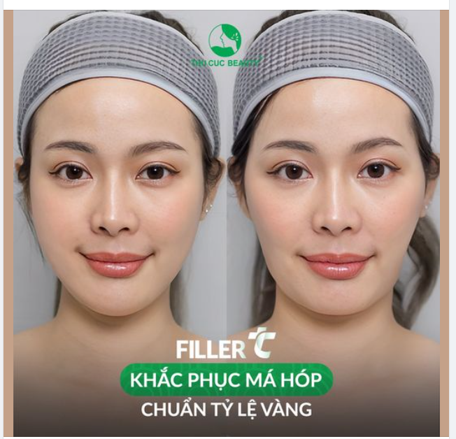 Đẹp đón Tết -46% Filler TC duy nhất 10 suất hôm nay