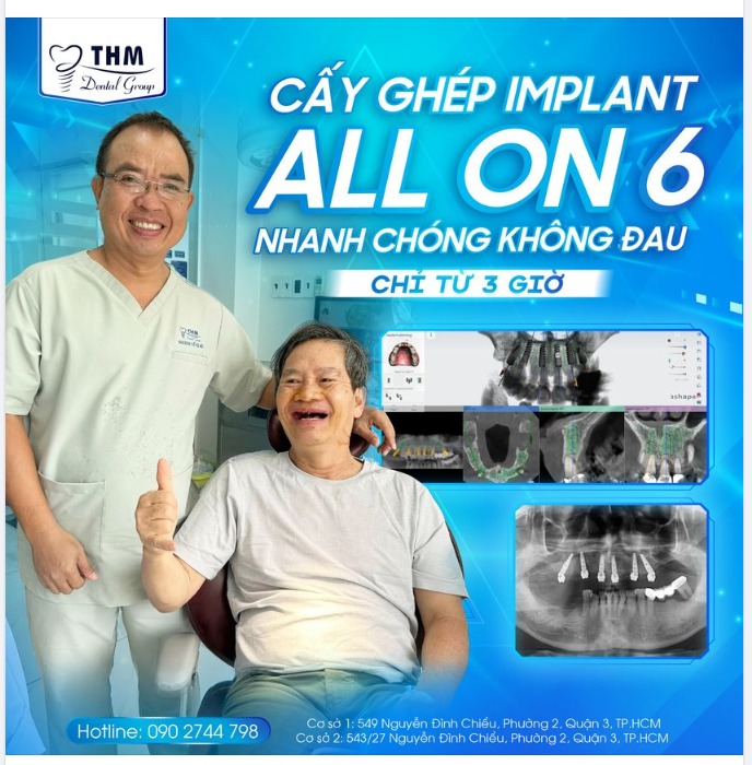 CẤY GHÉP IMPLANT ALL ON 6 NHANH CHÓNG KHÔNG ĐAU CHỈ TỪ 3H