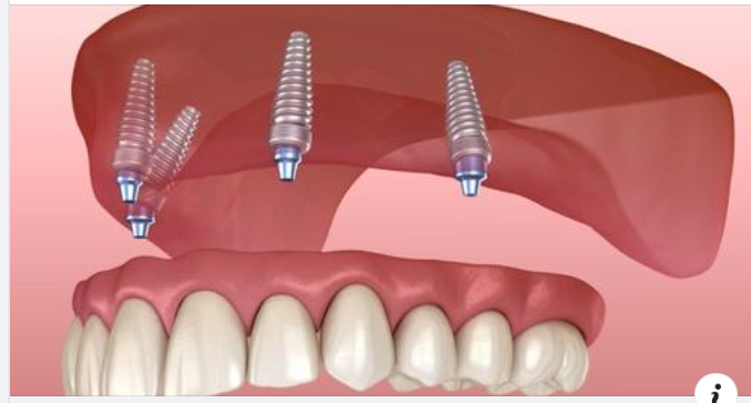 Các phương pháp trồng răng implant hiện nay