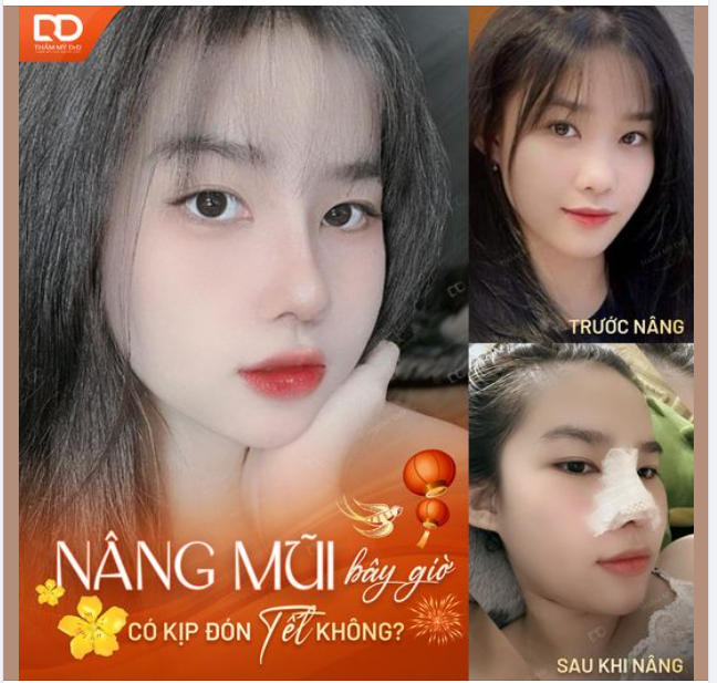 Nâng mũi bây giờ có kịp đón tết không?