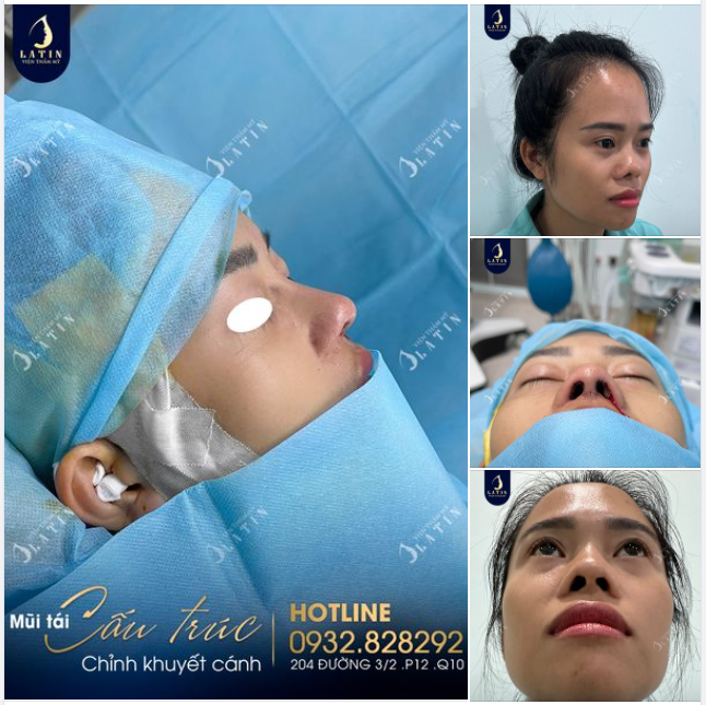 Khắc phục thành công tình trạng co rút đầu mũi cho khách hàng