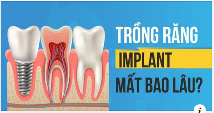 Trồng Răng Implant Mất Bao Lâu