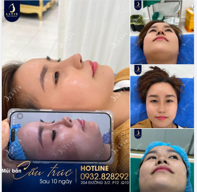 Ca mũi cấu trúc lót megaderm, xử lý chỉ mũi, 10 ngày cắt chỉ