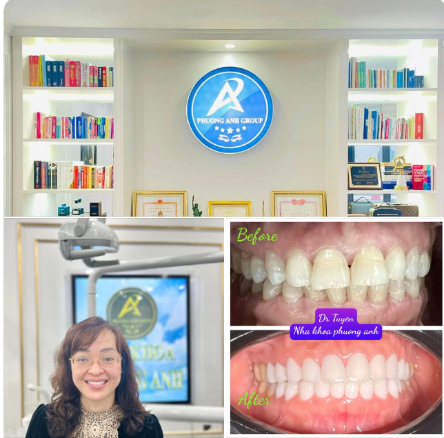 Hình ảnh nụ cười tỏa sáng của chị đẹp sau khi làm thẩm mỹ 20R sứ Nacera cao cấp