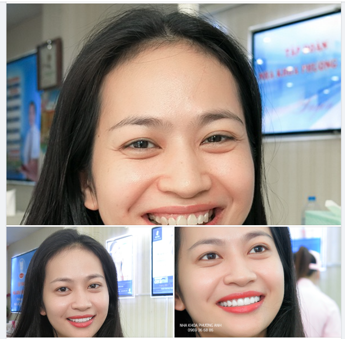Những biểu hiện sau khi bọc răng sứ
