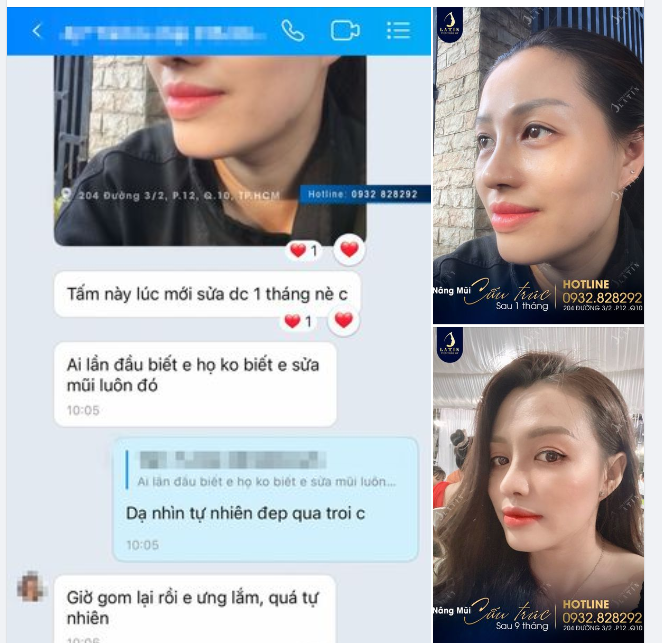 Phiên bản 1 tháng và 9 tháng mũi cấu trúc cho em gái