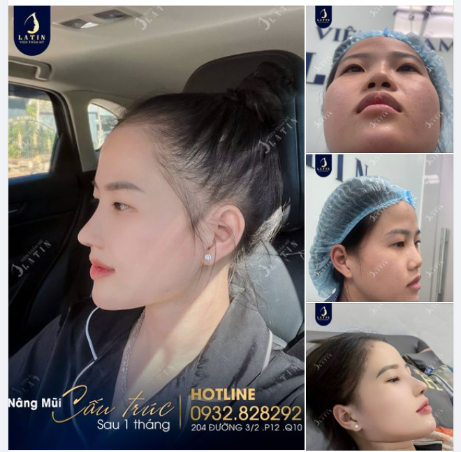 Mũi cấu trúc 1 tháng lên dáng đẹp cho em gái thích tự nhiên