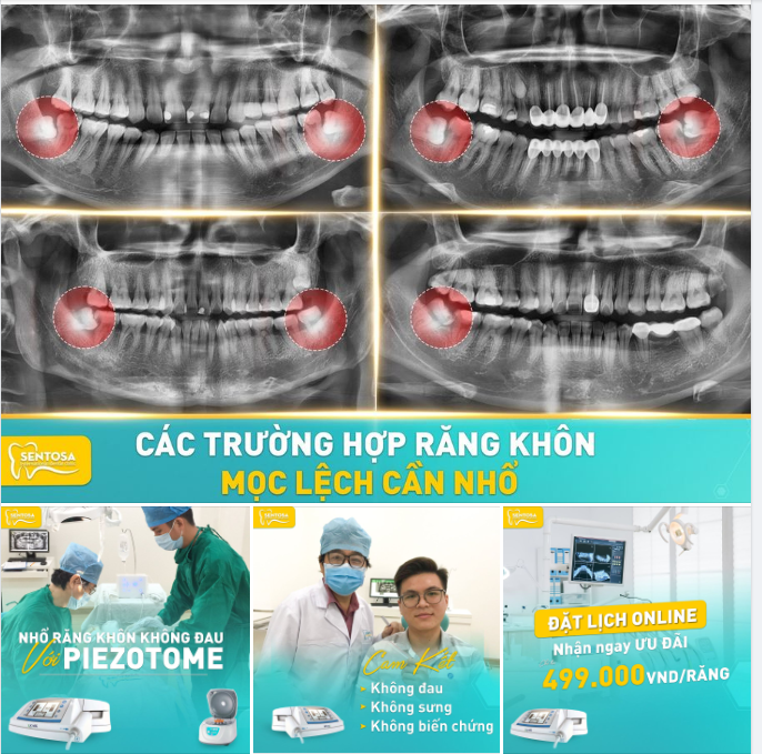 NHỔ RĂNG KHÔN TỰ TIN ĐÓN TẾT, KHÔNG LO ĐAU NHỨC TỪ 499K/RĂNG