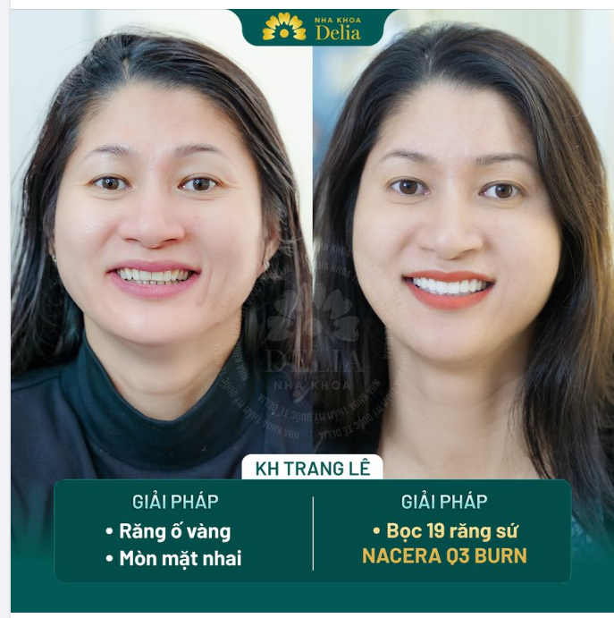 Bọc sứ không mài nhỏ răng - Xử lý răng ố vàng sau 48H