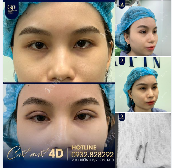 Cắt mí xinh, lung linh đón Tết. Thời điểm này cắt mí để ăn Tết quá là hợp luôn đó mấy nàng