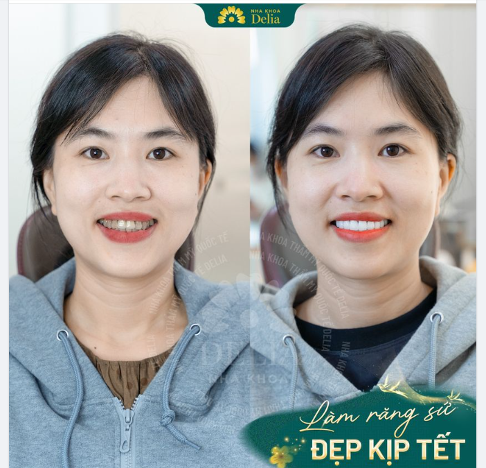 Thay đổi toàn diện nụ cười cho chị Thanh Trang (kiều bào Mỹ), khắc phục các tình trạng: