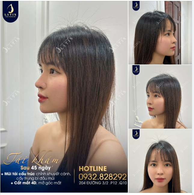 Em gái tái khám sau 45 ngày thực hiện combo
