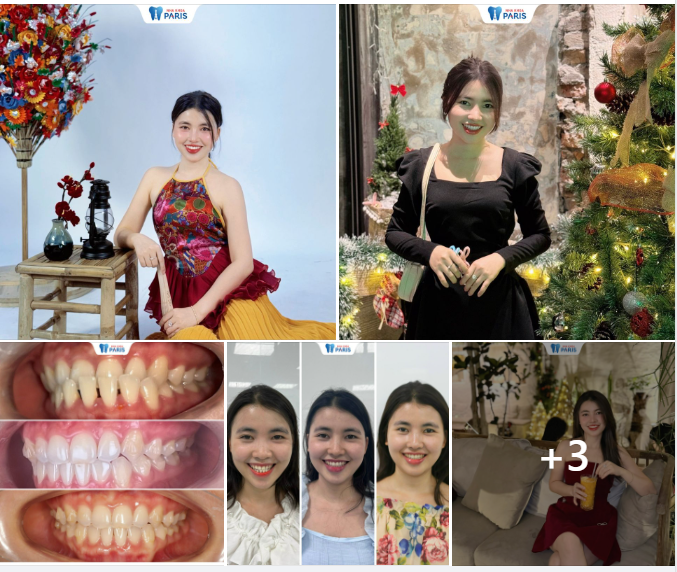 TỪ THƯA MÓM ĐẾN HOT GIRL VẠN NGƯỜI MÊ chỉ nhờ..... NIỀNG RĂNG INVISALIGN