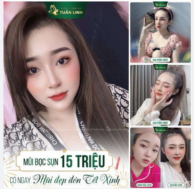 Mũi bọc sụn 15Triệu - Đẹp sang đón TẾT xinh!!