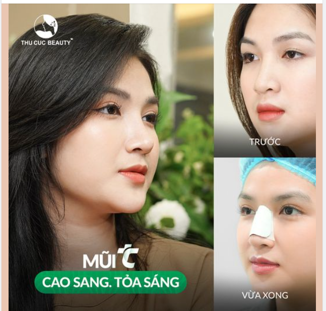 Mũi cao xinh tự tin đón tết