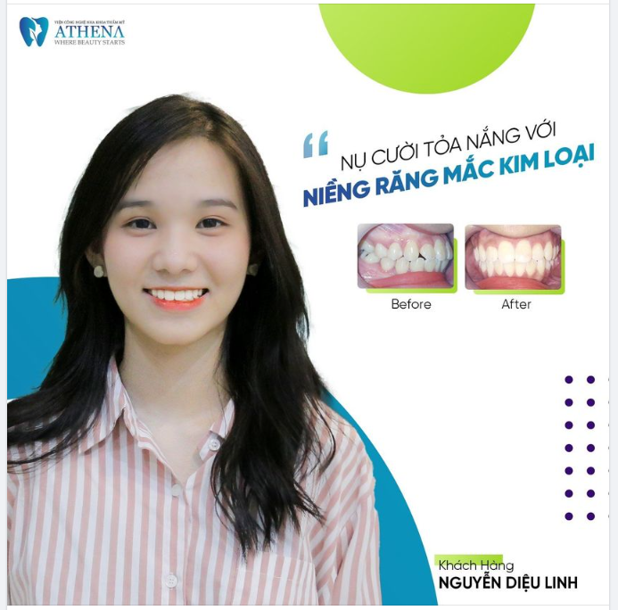Niềng răng  Những trường hợp nhất định không nên niềng răng