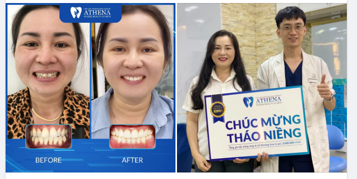 NIỀNG RĂNG TUỔI 30