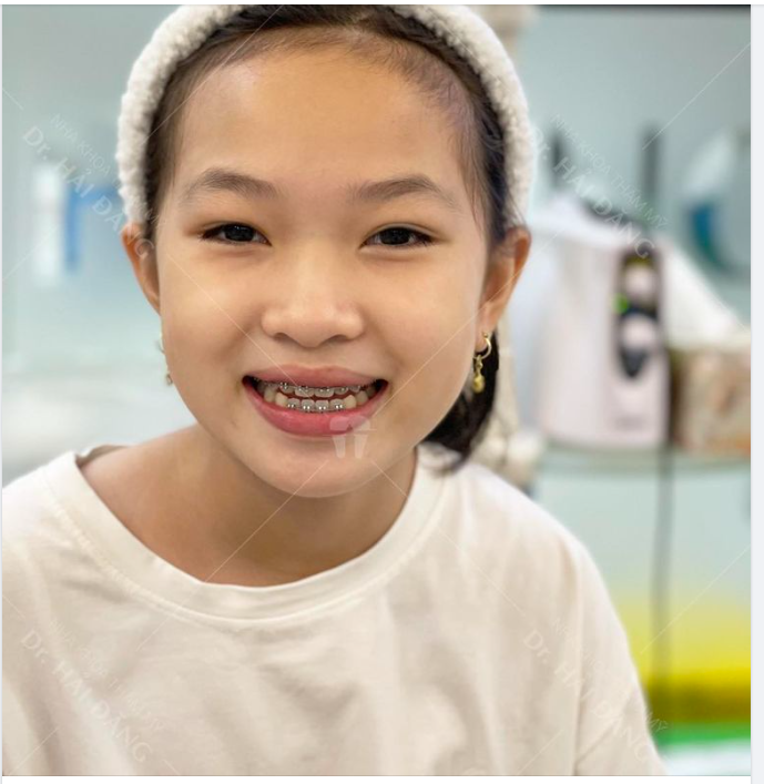 NÊN NIỀNG RĂNG SỚM CHO TRẺ EM