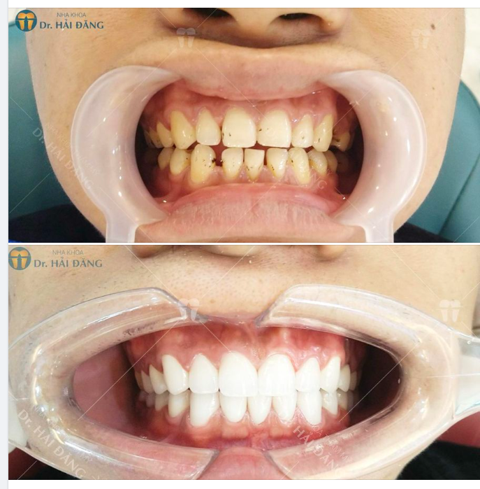 PHỤC HÌNH RĂNG SỨ THẨM MỸ CHO TRƯỜNG HỢP RĂNG THƯA