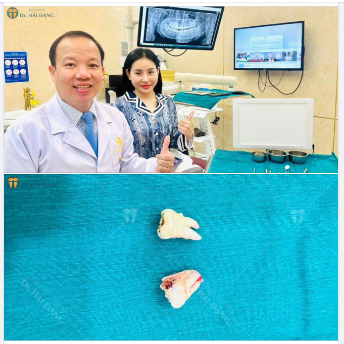 NHỔ RĂNG KHÔN VỚI TỐC ĐỘ SIÊU NHANH