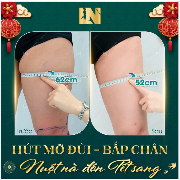 HÚT MỠ ĐÙI - BẮP CHÂN - NUỘT NÀ ĐÓN TẾT SANG