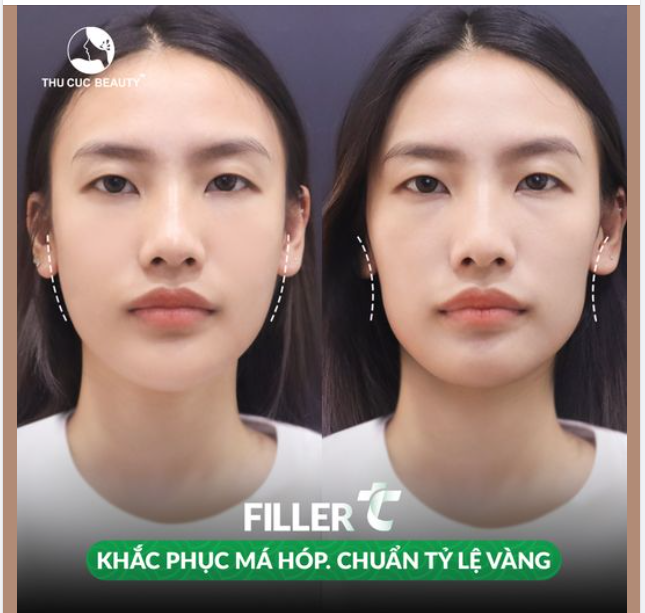 Filler TC duy nhất 10 suất -46% hôm nay đẹp ngay đón Tết