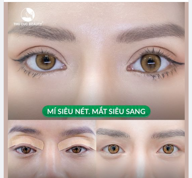 10 điểm cho nếp mí của khách hàng