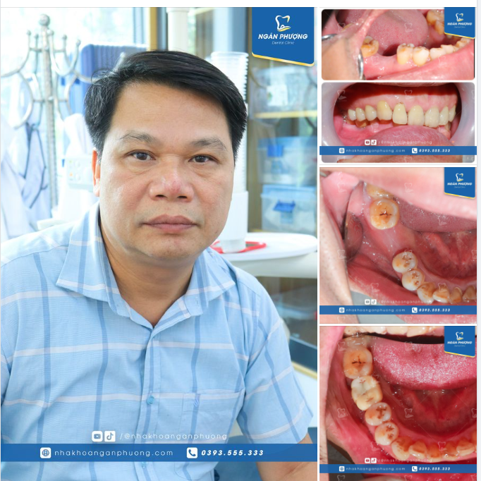 Thấy Ngân Phượng gần nhà nên qua trồng implant và cái kết
