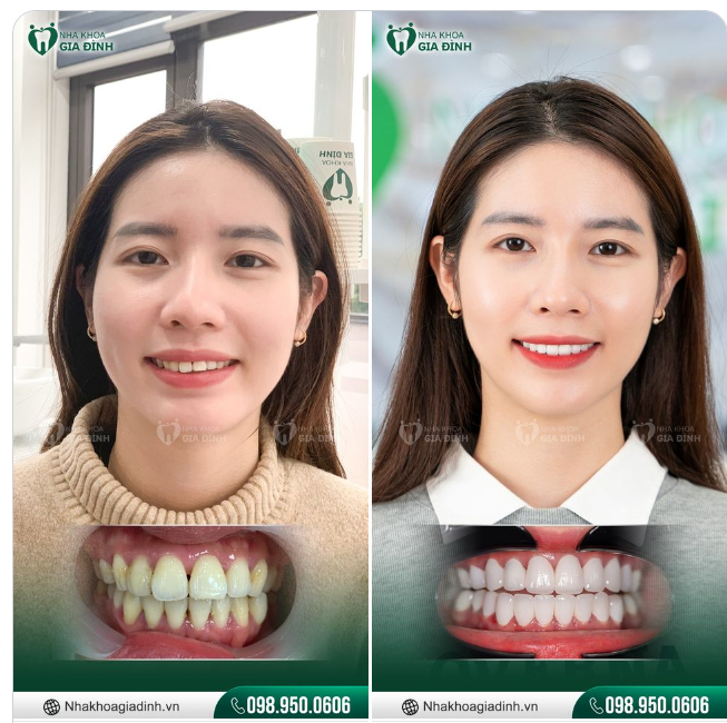 THAY ĐỔI CHỈ MỘT CHI TIẾT NHỎ THÔI CŨNG LÀM GƯƠNG MẶT THÊM BỪNG SÁNG