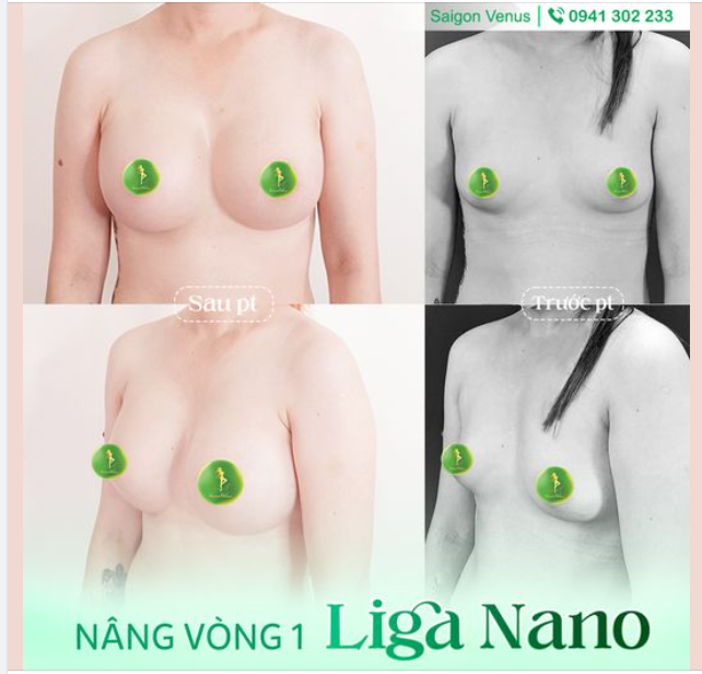 ƯU ĐIỂM CỦA PHƯƠNG PHÁP NÂNG V1 LIGA NANO