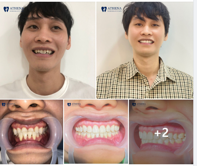 ĐỘNG LỰC DÀNH CHO NHỮNG BẠN BỊ KHỚP CẮN NGƯỢC NHÉ