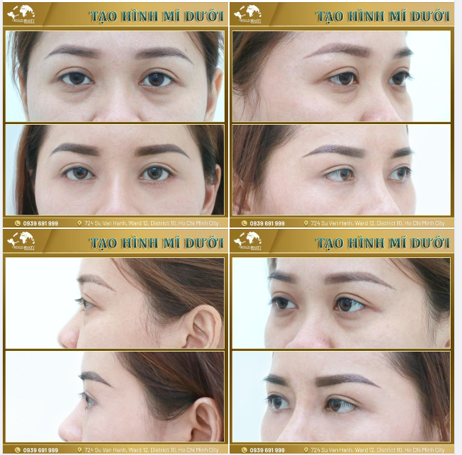 Trẻ hóa toàn diện đôi mặt bằng phẫu thuật cắt mí dưới kết hợp di chuyển mỡ 