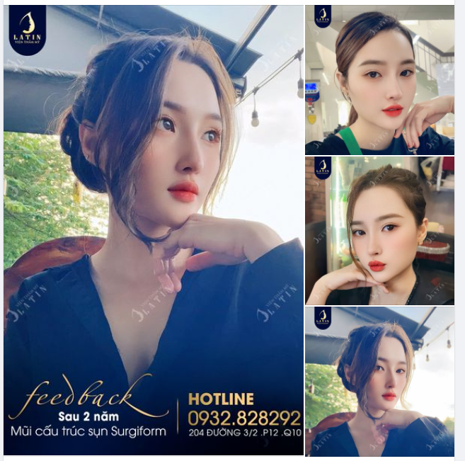 Mũi cấu trúc 2 năm làm xao xuyến bao trái tim