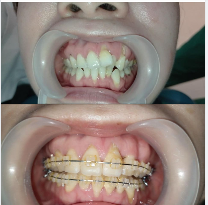 Hành Trình Thay Đổi Tuyệt Vời - Niềng Răng Trong 6 Tháng của Tôi
