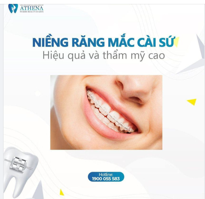 NIỀNG RĂNG MẮC CÀI SỨ - SỰ LỰA CHỌN HOÀN HẢO CHO NỤ CƯỜI TỰ TIN
