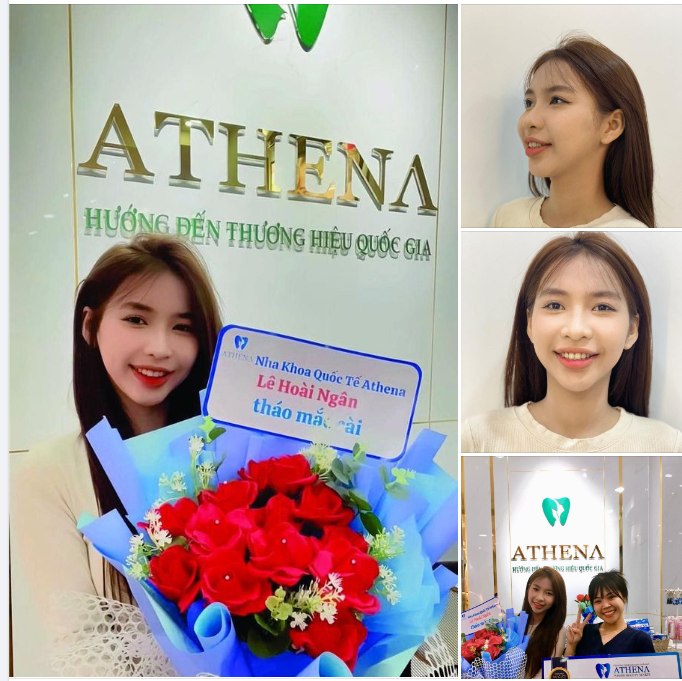 Tháo Niềng Răng Thành Công: Hành Trình Tự Tin Tới Năm 2024