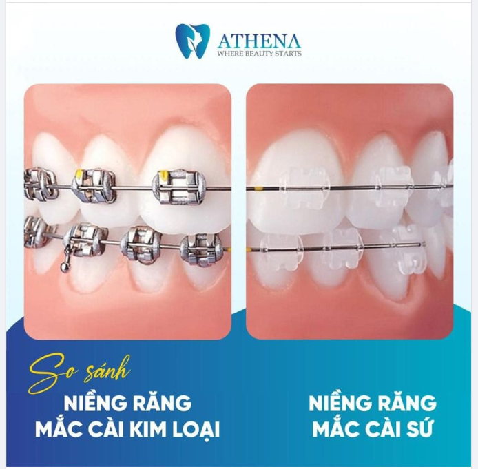 SO SÁNH MẮC CÀI KIM LOẠI VÀ MẮC CÀI SỨ
