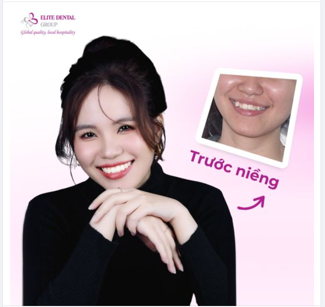 NIỀNG RĂNG CẢI THIỆN RĂNG NANH MỌC CAO, NÂNG TẦM NHAN SẮC CHO PHỤ NỮ HIỆN ĐẠI