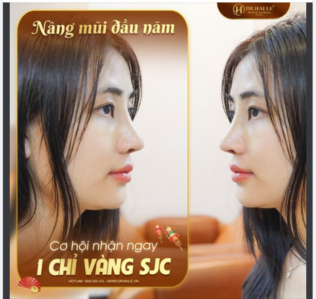 Bạn không nhìn nhầm đâu! Chỉ cần qua Dr.Hải Lê nâng mũi trong tháng 2 này, không chỉ có thể sở hữu dáng mũi đẹp đến từng milimet mà còn nhận ngàn ưu đãi cực HOT: