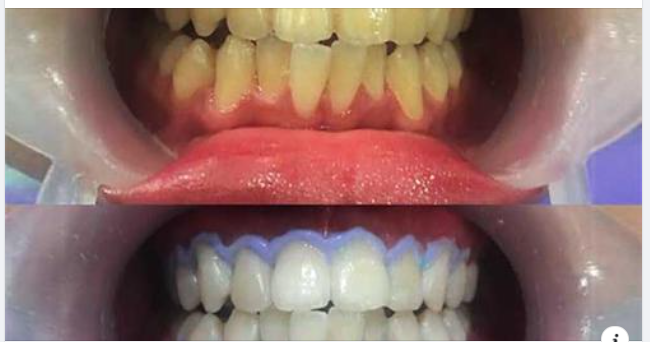 Sự đổi màu răng – Nguyên nhân và cách phòng tránh