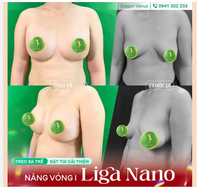 V1 CHUẨN TỶ LỆ VÀNG VỚI NÂNG V1 LIGA NANO