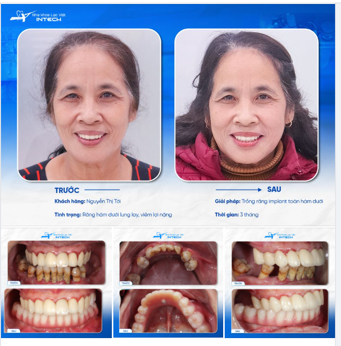 TRỒNG RĂNG IMPLANT CÔNG NGHỆ DCT - THỎA ƯỚC NGUYỆN ĂN NHAI TRỌN VẸN CỦA BỆNH NHÂN MẤT RĂNG