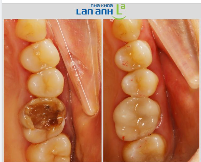 Răng bị bể vỡ khi ăn Tết rồi, giờ làm lại có khó không bác sĩ?