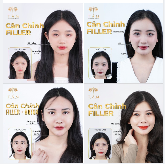 Khắc phục thái dương hõm, má hóp, cằm lẹm chỉ sau 30 phút
