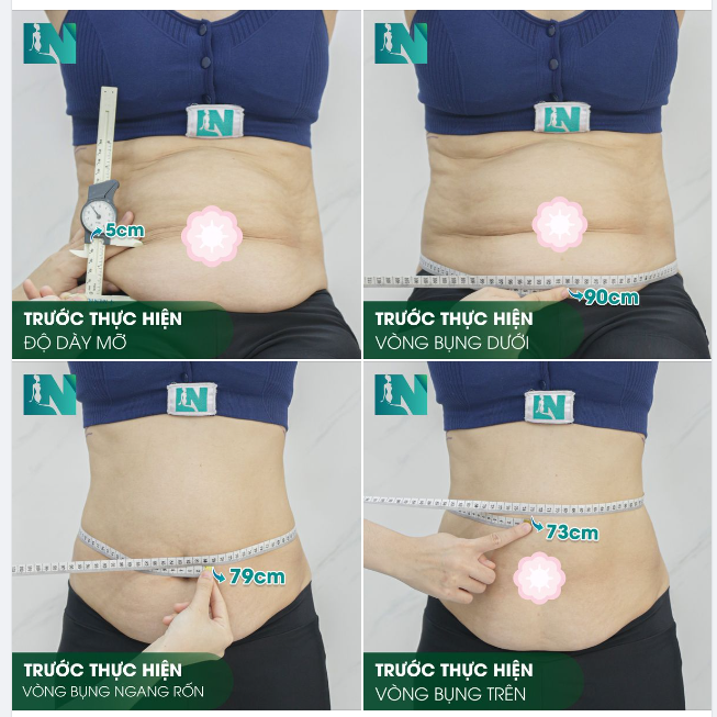 HÌNH ẢNH TRƯỚC KHI THỰC HIỆN HÚT MỠ TẠO DÁNG BỤNG - EO - HÔNG CỦA CHỊ HIỀN
