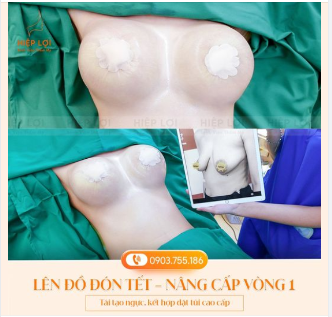 Với phương pháp nâng ngực độc quyền, tại Hiệp Lợi, rất nhiều khách hàng đã thay đổi diện mạo và tự tin hơn với vòng 1 lý tưởng.